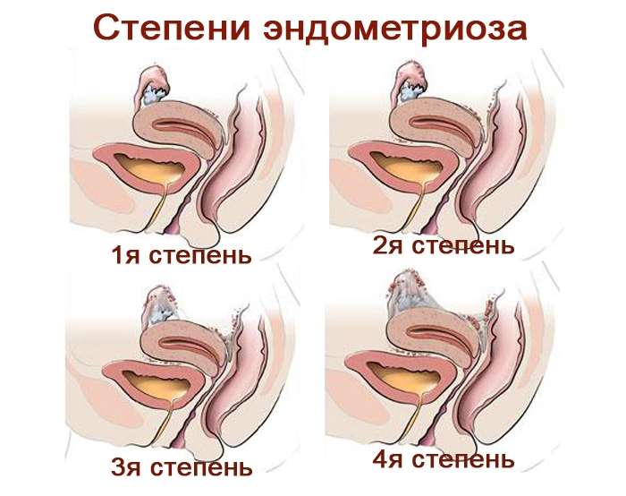 Болезнь эндометриоз как лечить эндометриоз у женщин - Астролодиан