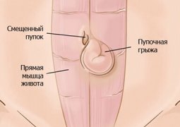 Невправимая пупочная грыжа у женщин: симптомы, лечение, профилактика